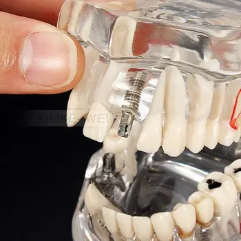 Öğretim Çıkarılabilir Diş İmplantı Hastalık Modeli & Restorasyon Köprü Diş Diş
